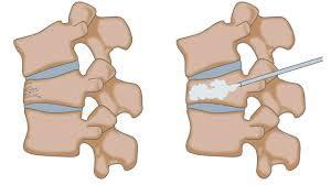Fracturas vertebrales